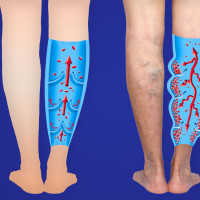 Doppler tętnic kończyn dolnych