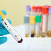 Marker fPSA - badanie laboratoryjne
