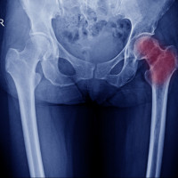 RTG miednica, stawy biodrowe AP