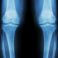 RTG stawów kolanowych - 2 kolana porównanie