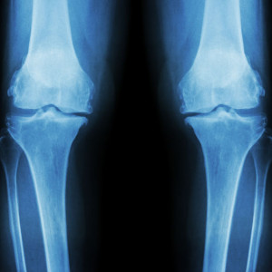 RTG stawów kolanowych - 2 kolana porównanie