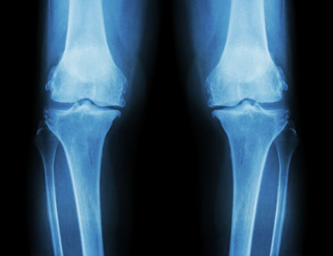 RTG stawów kolanowych - 2 kolana porównanie