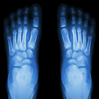 RTG stopy dwie - porównanie