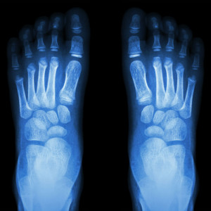 rtg-stopy-dwie-porównanie-etermed RTG stopy dwie - porównanie