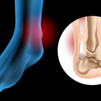 USG ścięgna achillesa
